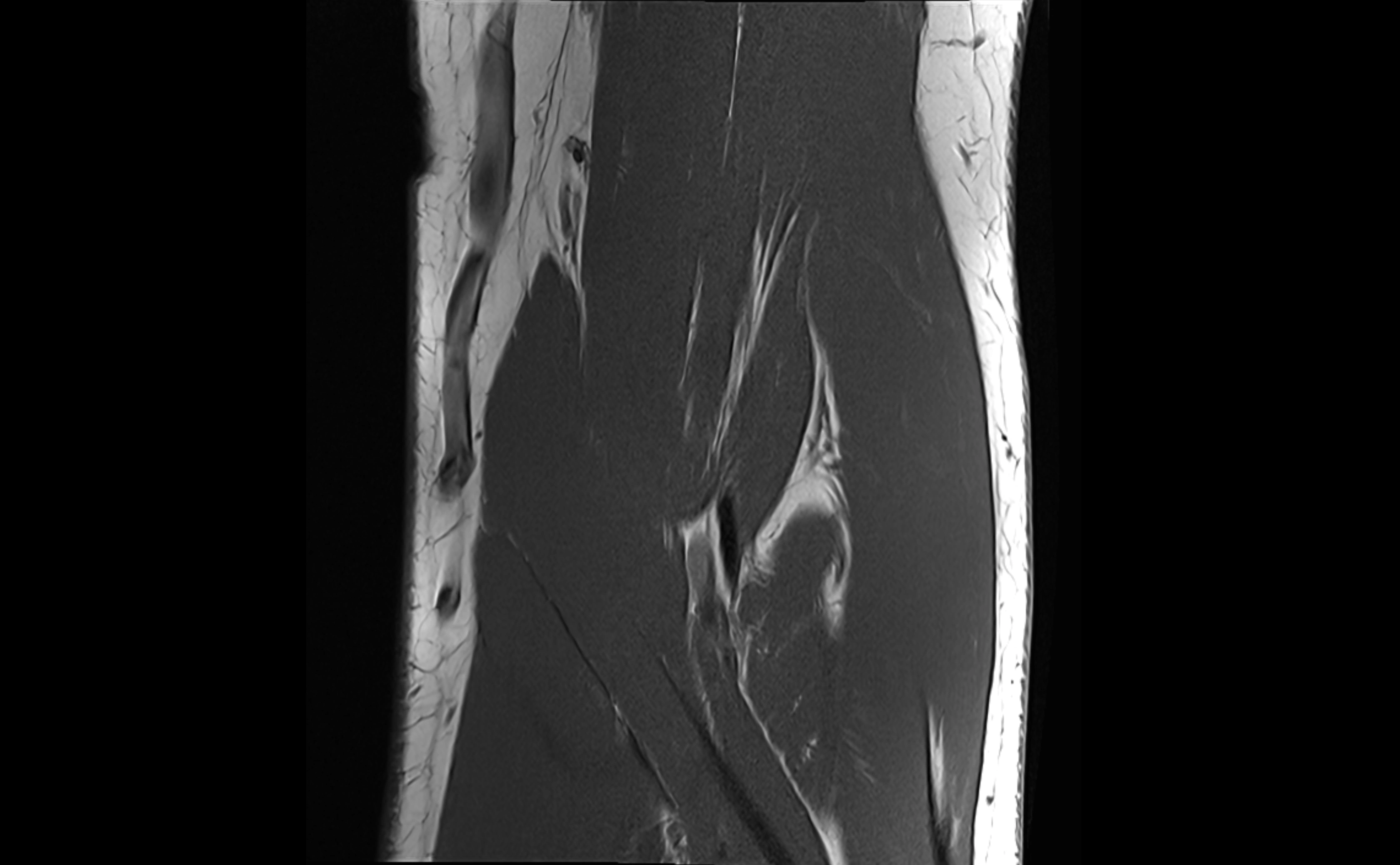 MRI elbow ligaments coronal cross sectional anatomy 3T  radiology  image-img-07001-00013.webp